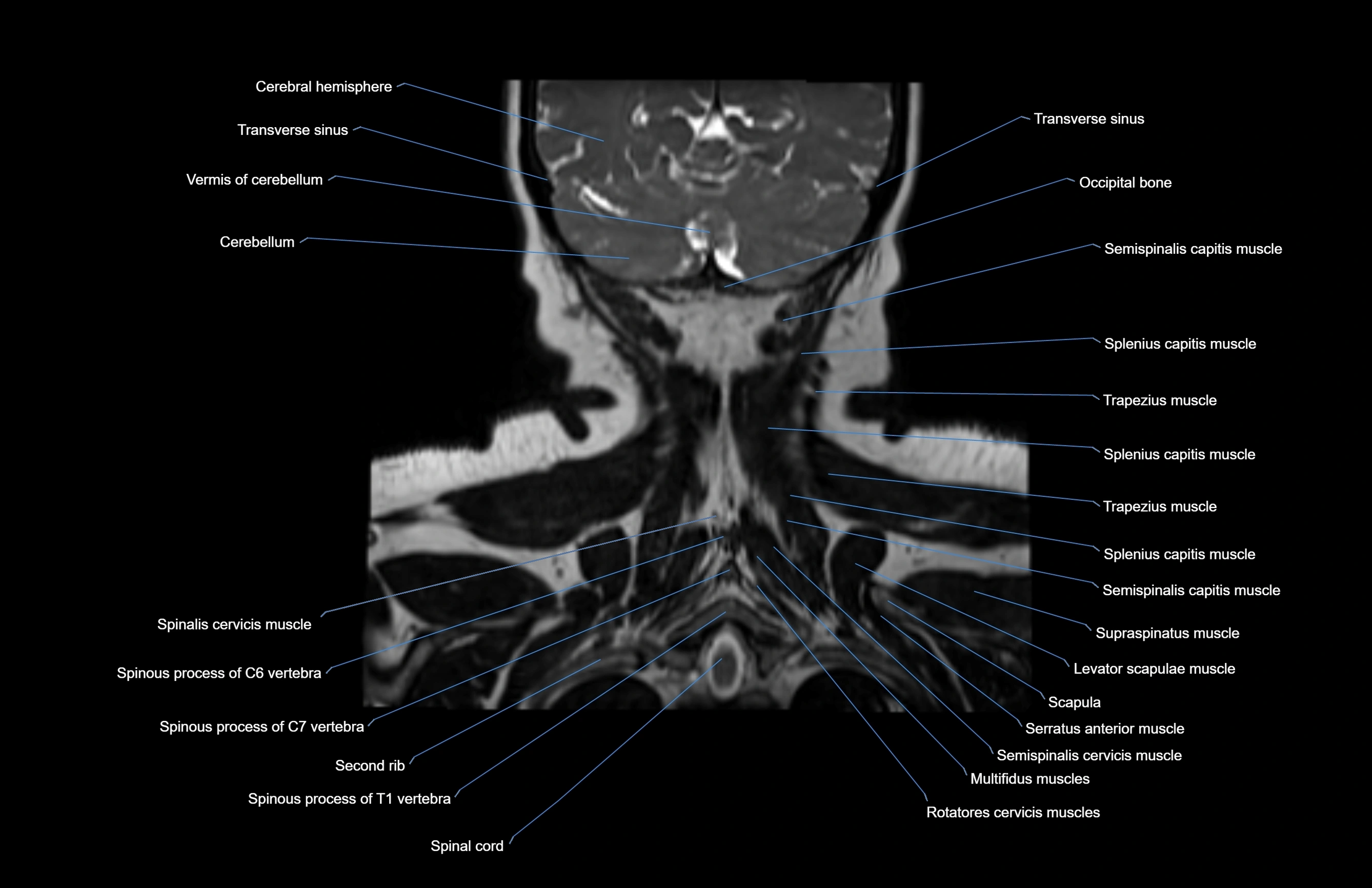 Neck coronal cross sectional MRI anatomy 3T MRI  image-img-00001-00009.webp